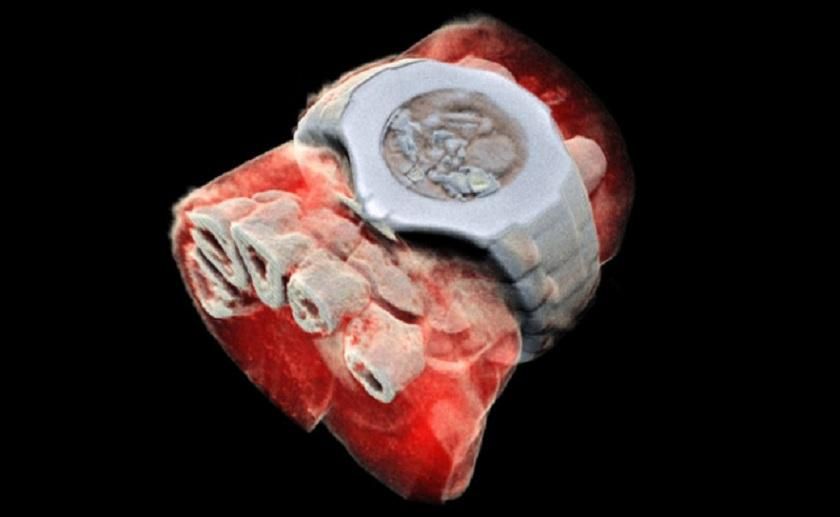 На людині вперше випробували кольоровий рентген: знімки На людині вперше випробували кольоровий рентген: знімки