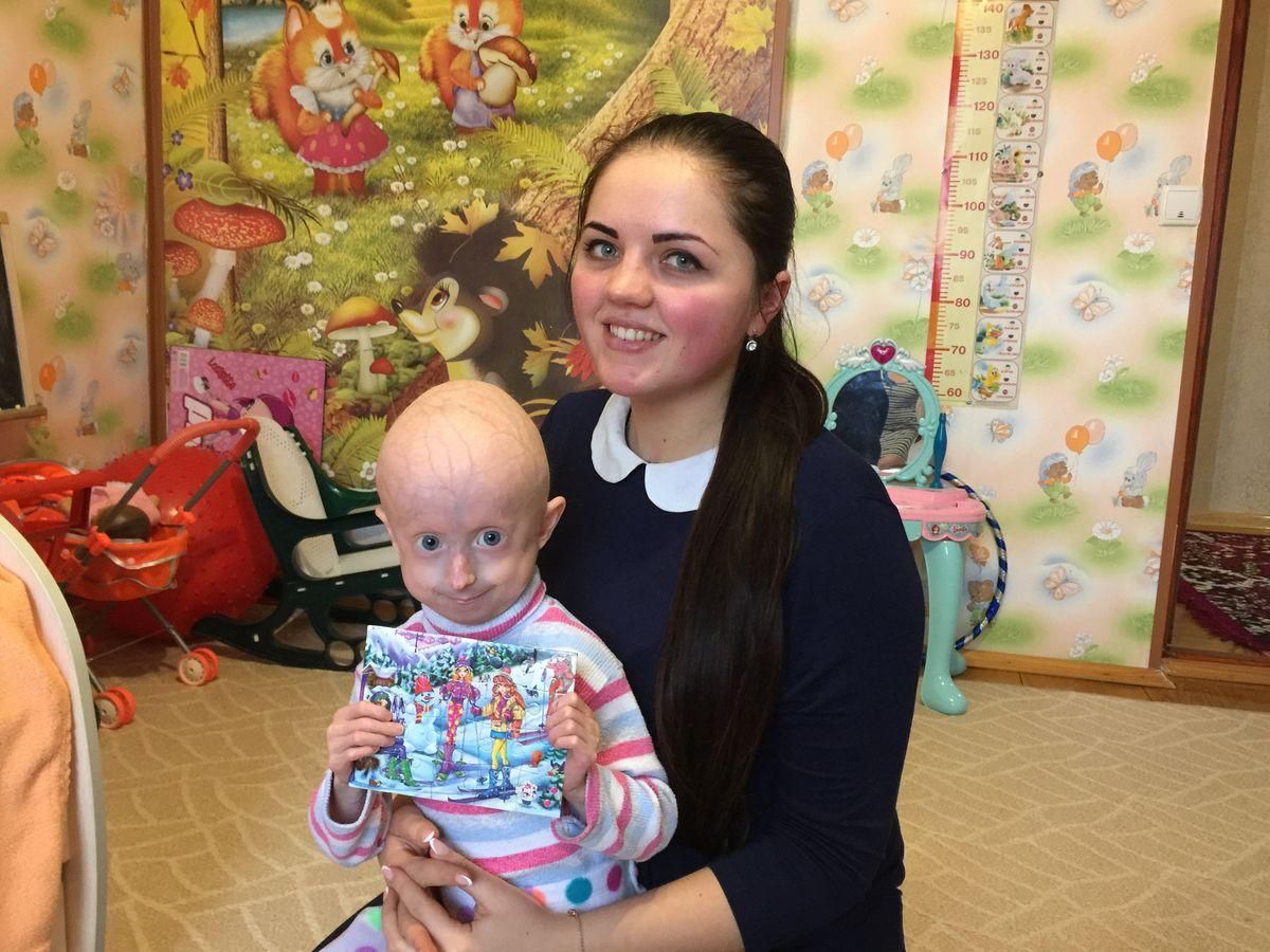 Украинские врачи прооперировали единственную в стране "стареющую" девочку Украинские врачи прооперировали единственную в стране "стареющую" девочку