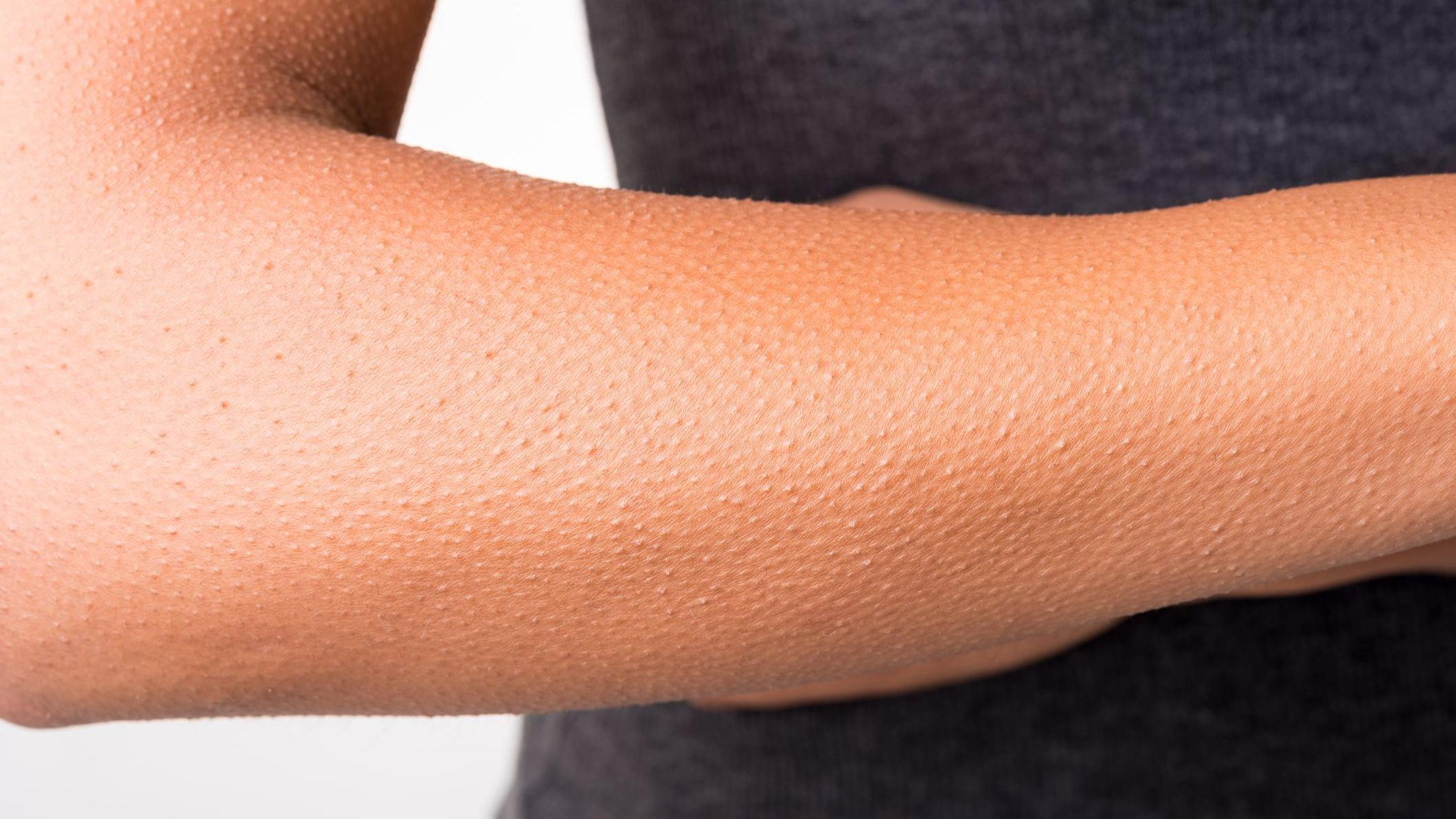 О чем свидетельствует способность чувствовать гусиную кожу