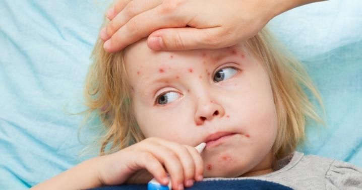 Спалах кору на Івано-Франківщині: захворіли вакциновані діти