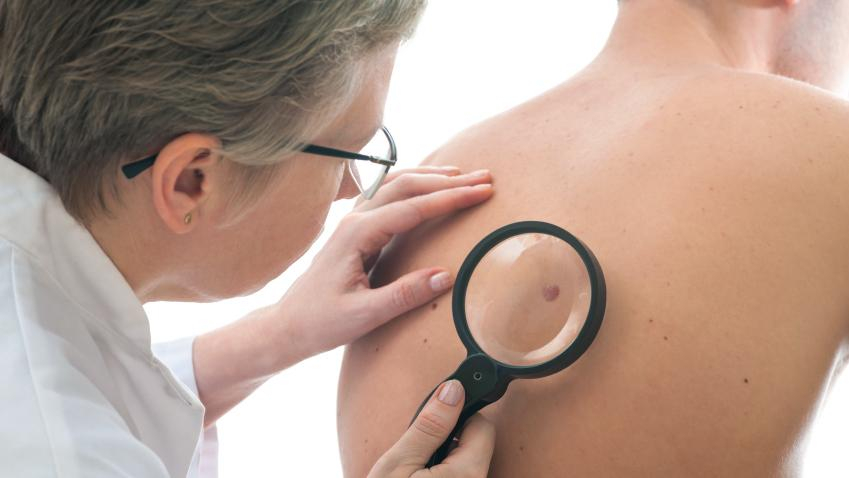 Четыре мифа об удалении родинок, в которые не нужно верить