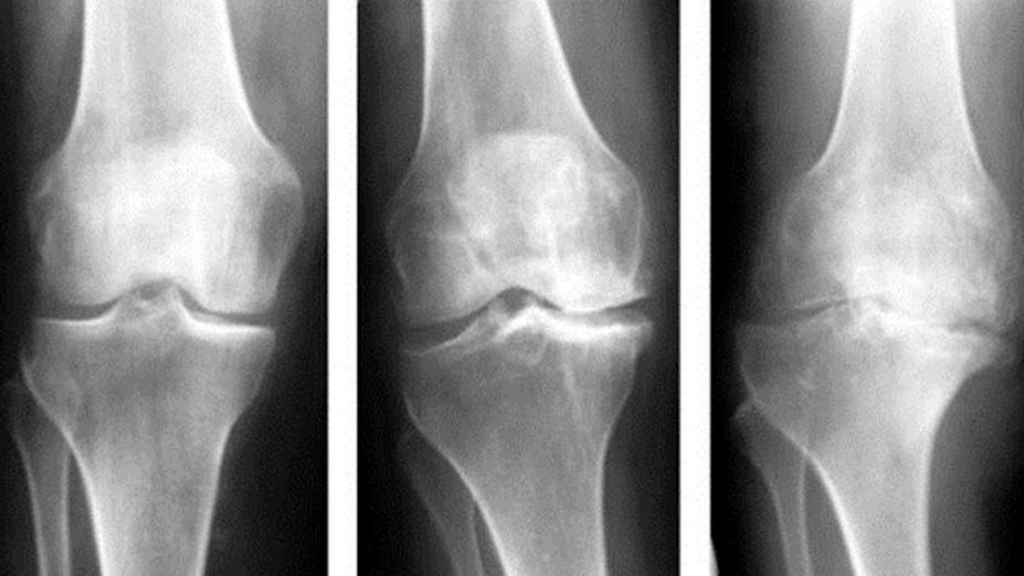 Почему болят руки: основные причины возникновения артроза
