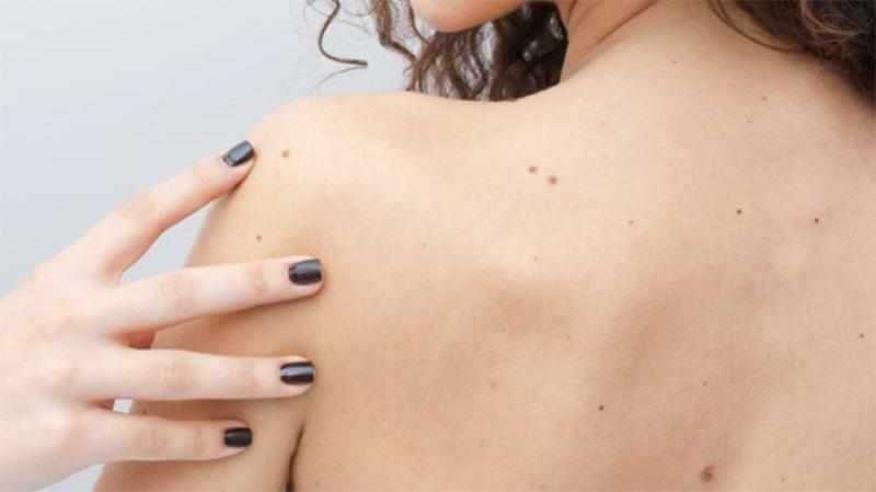 Белие пятна вокруг родинки – что это, особенности, как лечить 