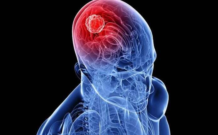 Які симптоми раку мозку на ранніх стадіях