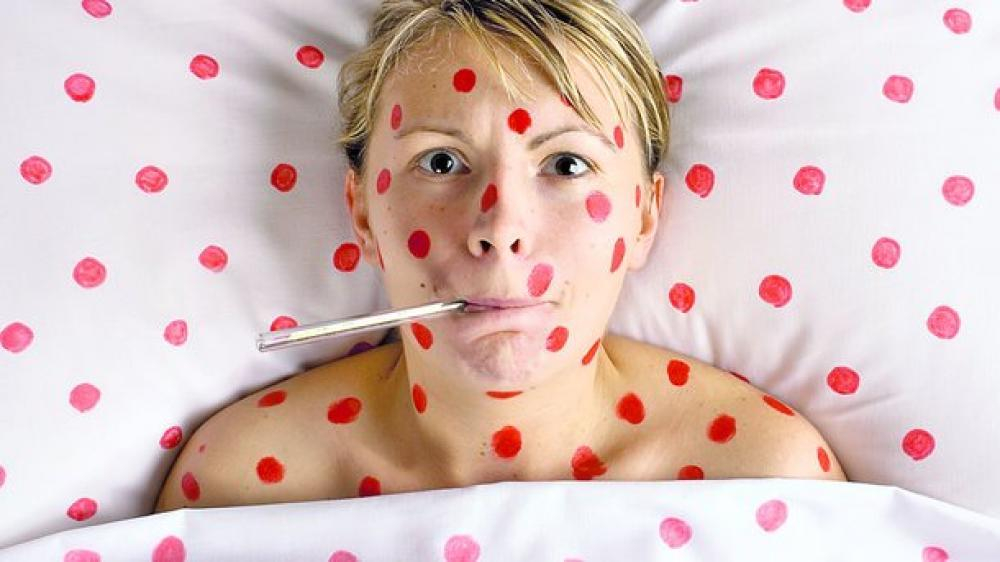 Более 2 тысяч украинцев заболели корью за неделю: данные Минздрава