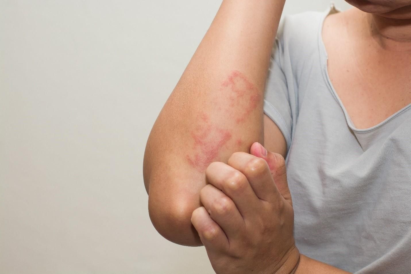 Люди придумывают себе аллергию, которой у них нет: исследование