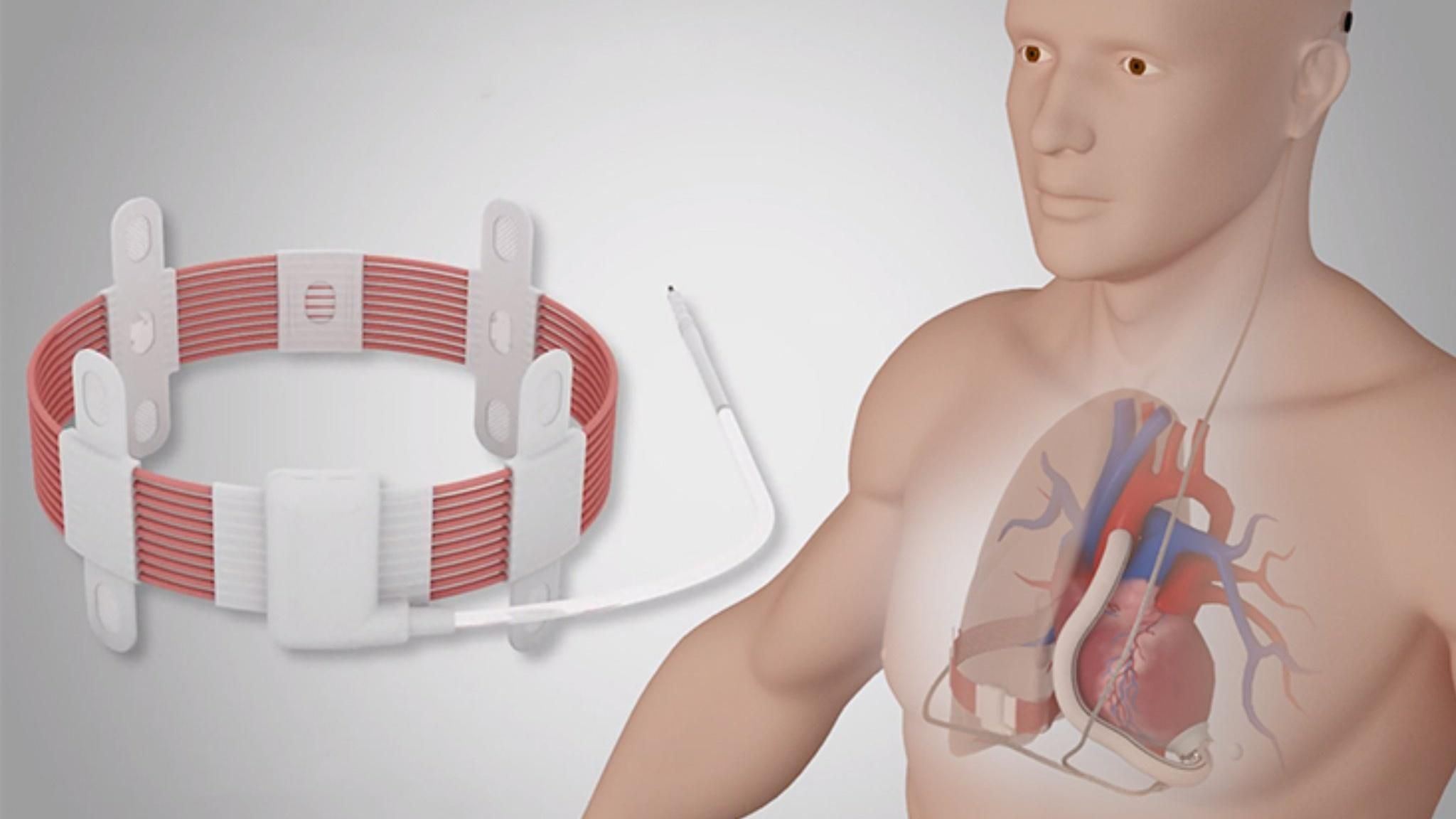 Вчені вперше вживили штучне серце з можливістю бездротової зарядки