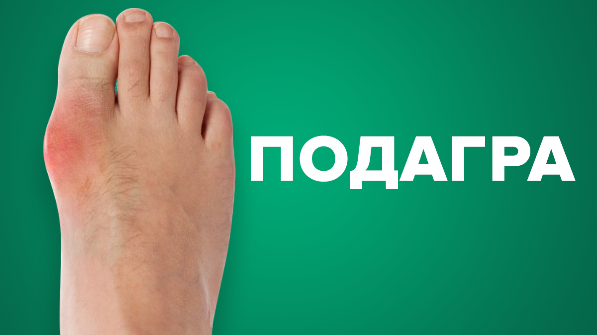 Что такое подагра и как её лечить - симптомы, причины