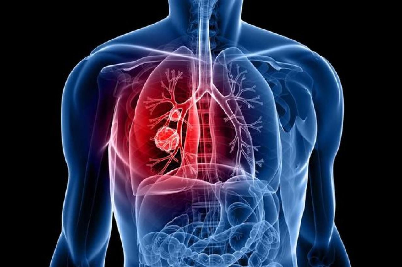 Десять міфів про туберкульоз та їхнє спростування
