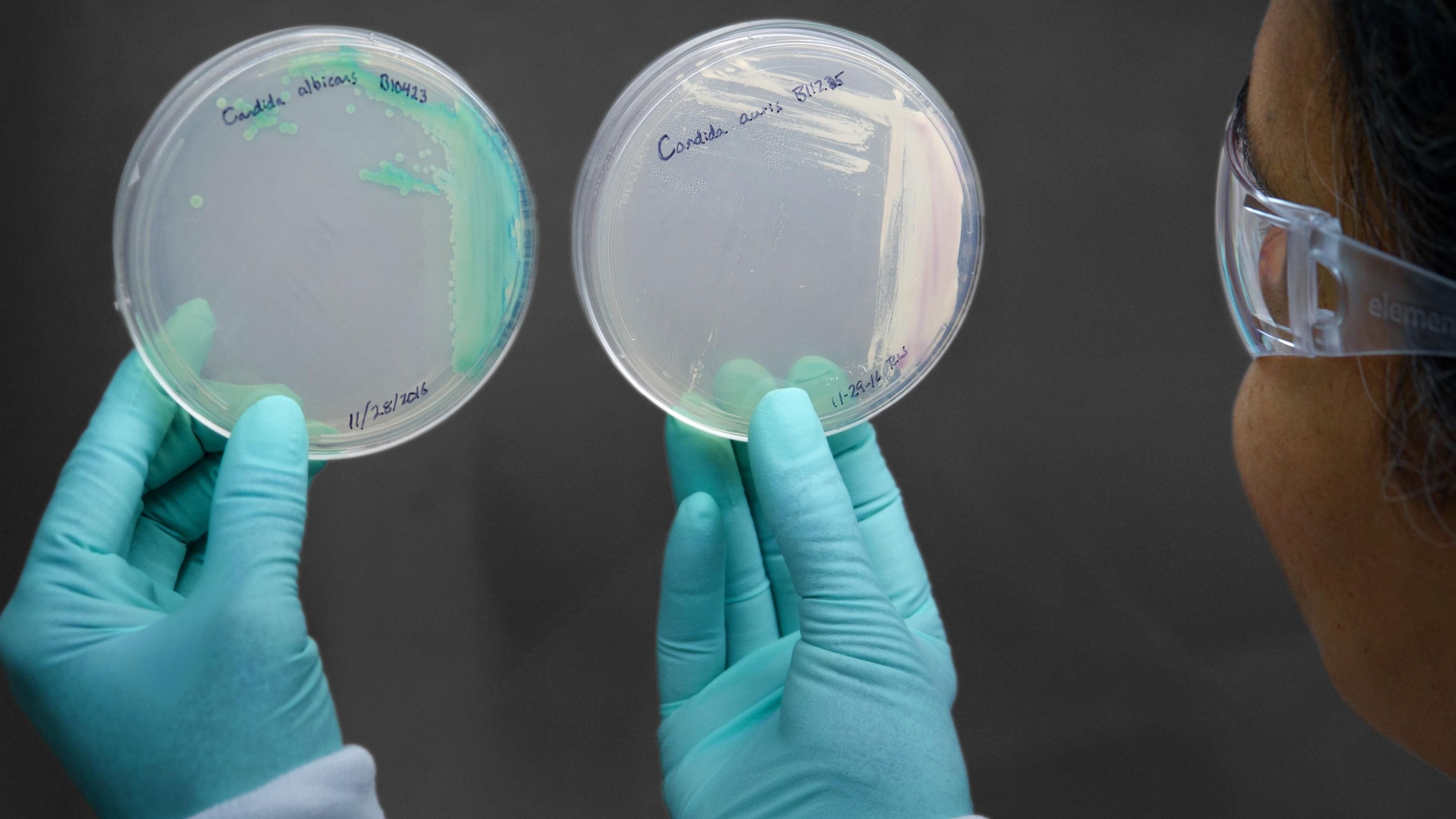 Смертельный грибок Candida auris - симптомы и лечение Смертельный грибок Candida auris - симптомы и лечение