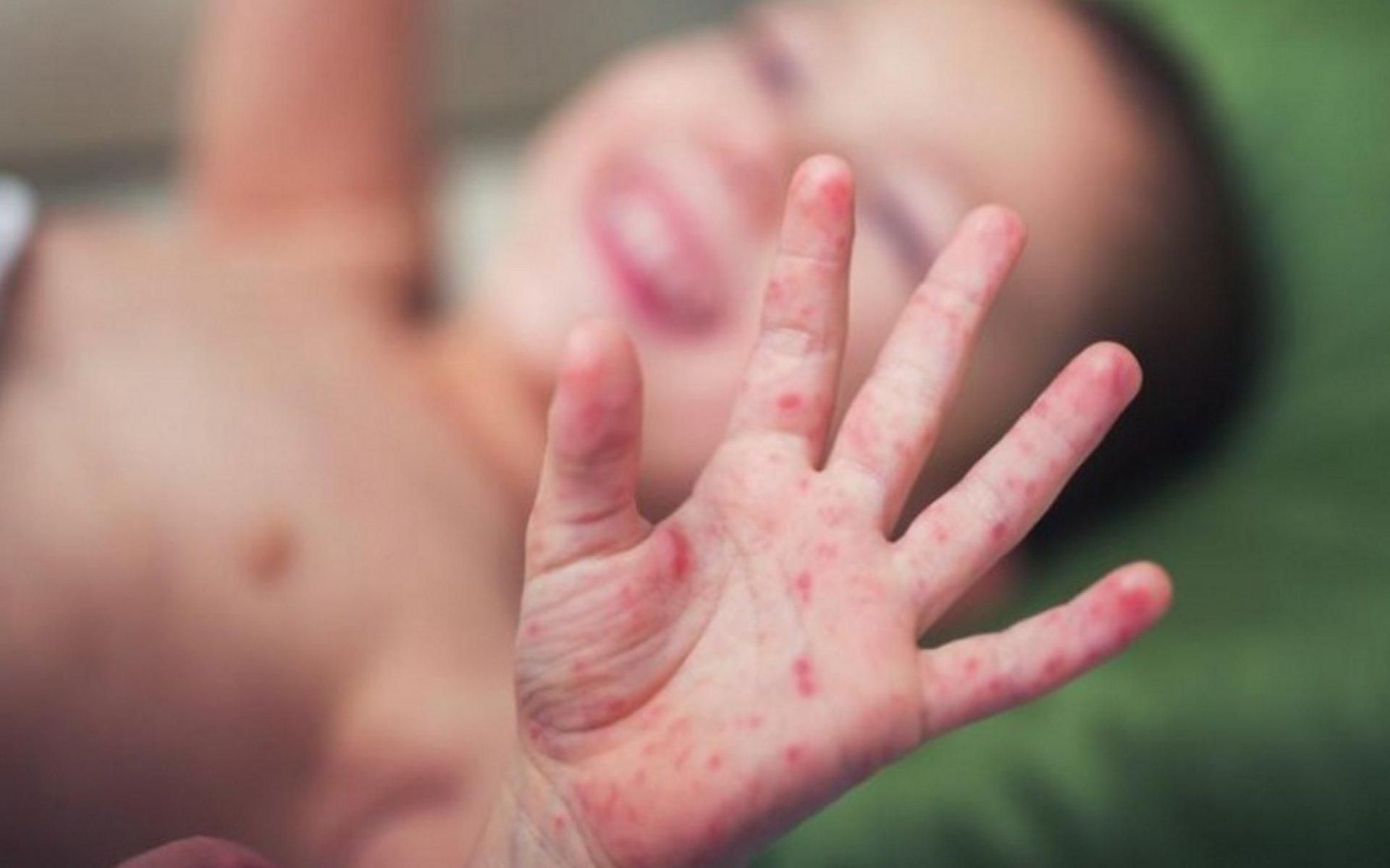 70% усіх випадків кору в Європі зафіксовані в Україні 70% усіх випадків кору в Європі зафіксовані в Україні