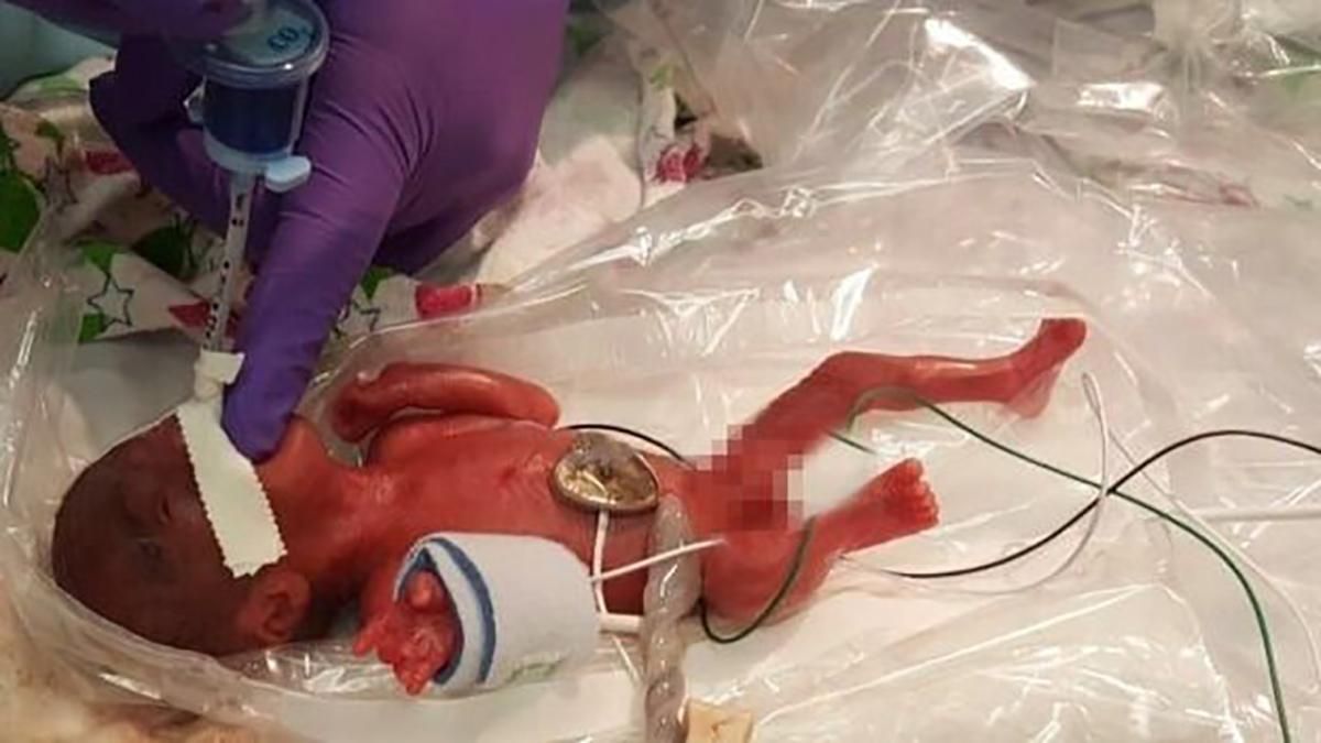 Ребенок весом с яблоко: самую маленькую в мире новорожденную девочку выписали из больницы – фото