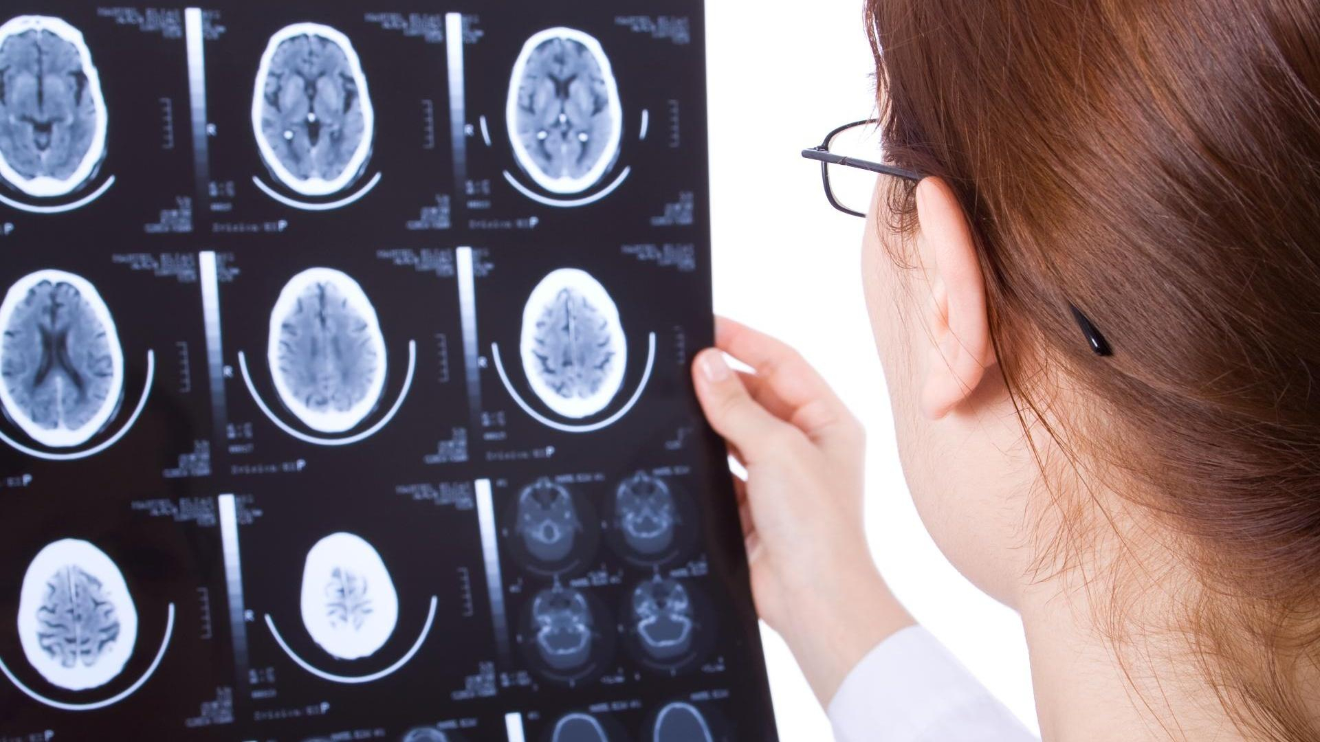 За 40 лет до болезни Альцгеймера: назвали первый признак