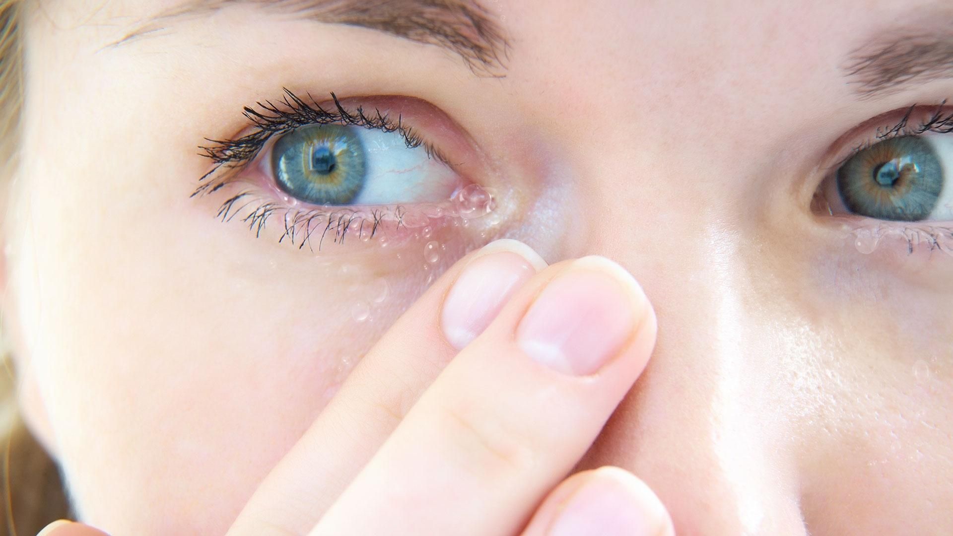 Назвали самые распространенные аллергические болезни глаз