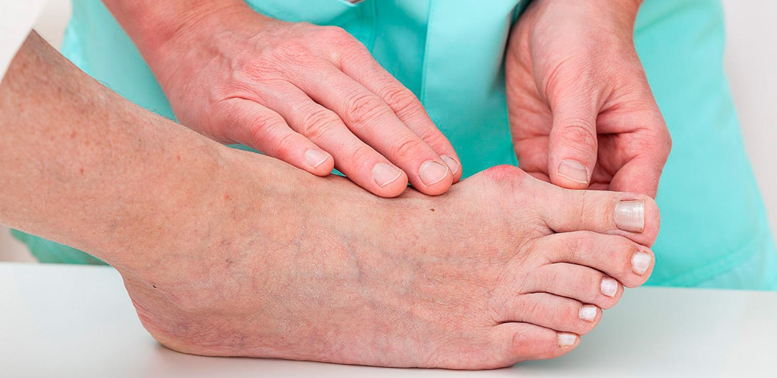 Самые распространенные мифы про подагру