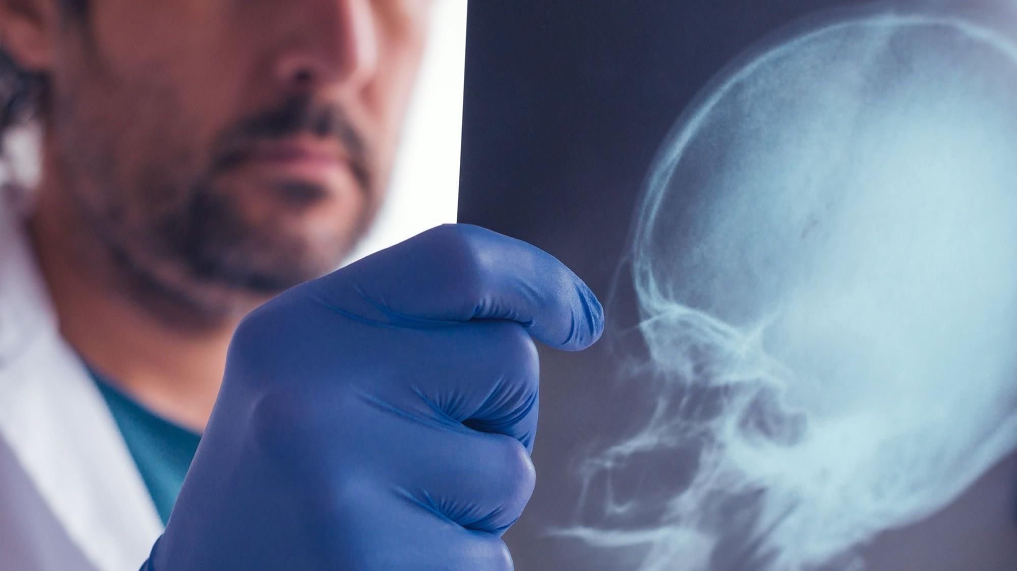 Даже один удар по голове может привести к необратимым болезням Даже один удар по голове может привести к необратимым болезням