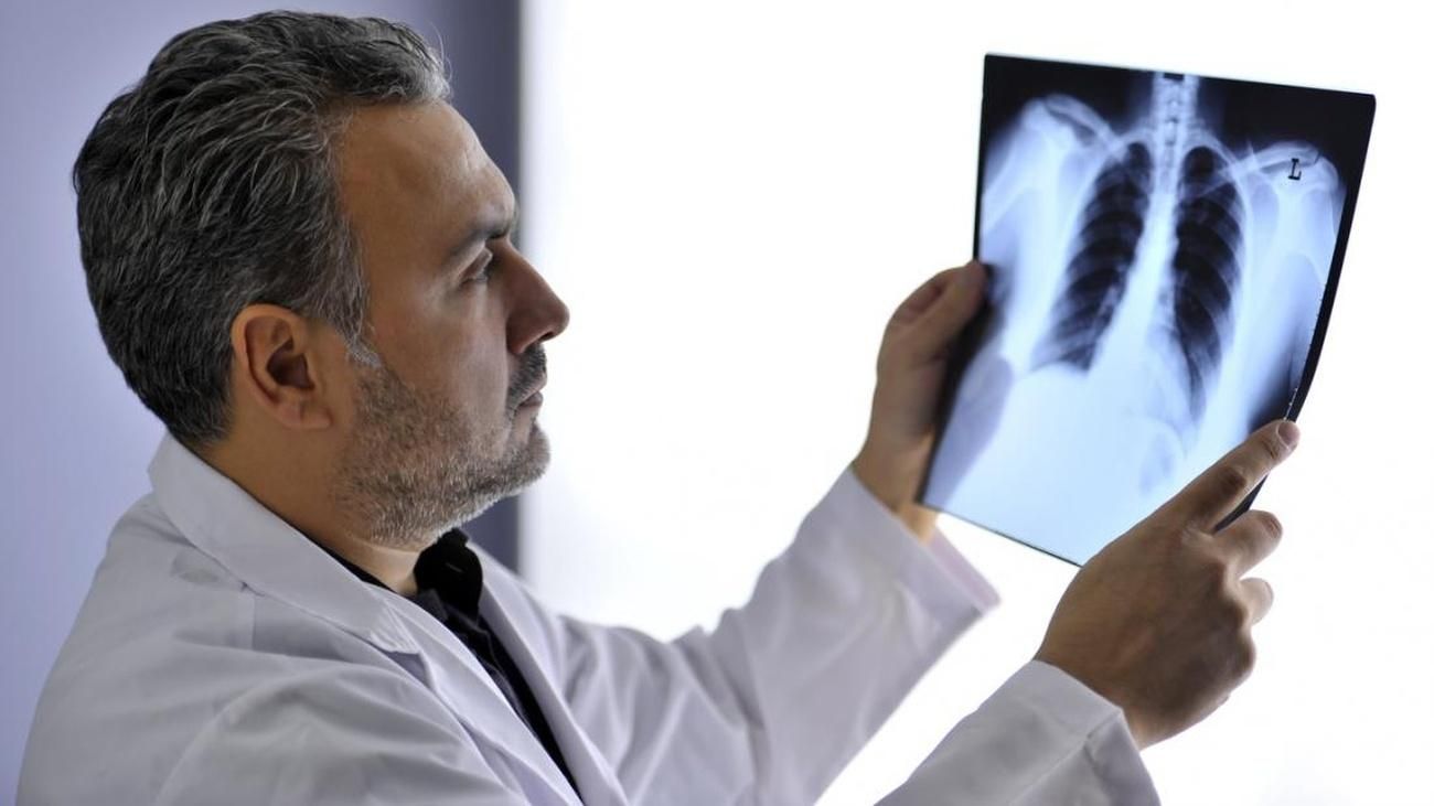 Новий аналіз може виявити рак легень на першій стадії