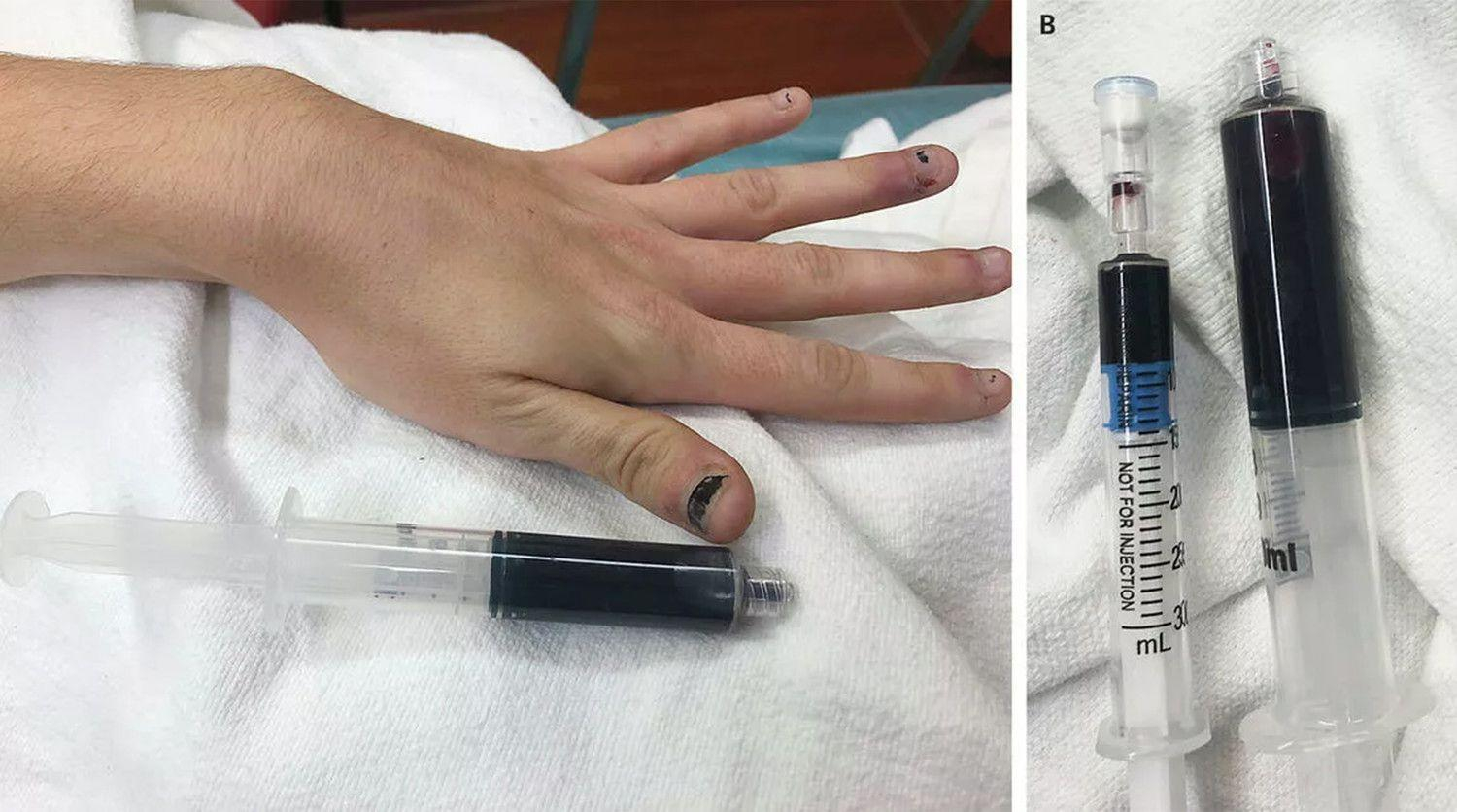 Кровь девушки посинела из-за обезболивающего: фото