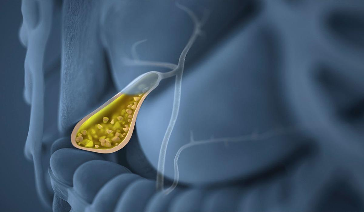 Ученые открыли механизм образования камней в желчном