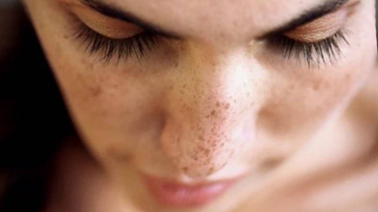 Пигментация кожи – причины, как избавиться от пигментации