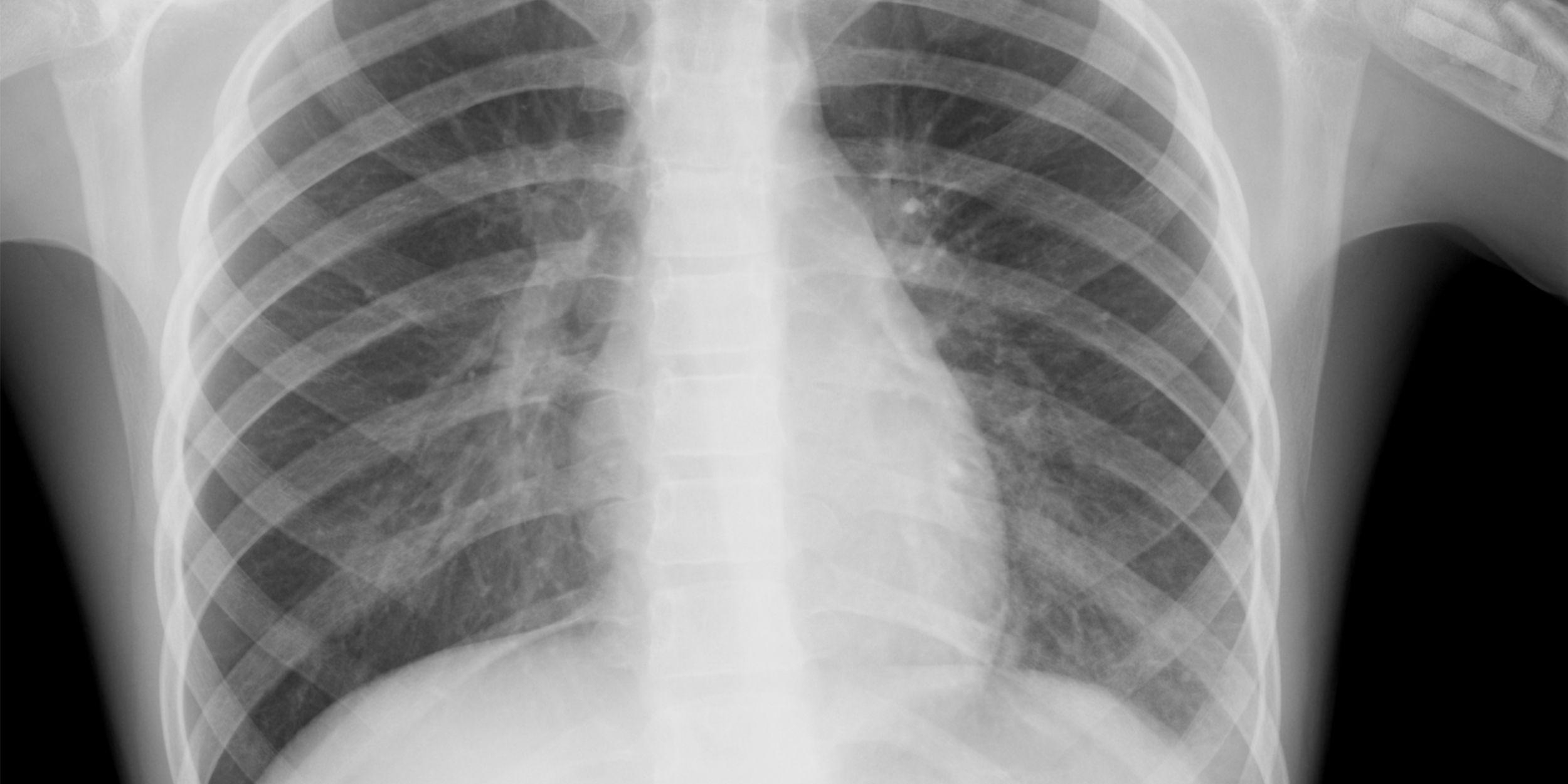 В Черновицкой области от пневмонии умер человек