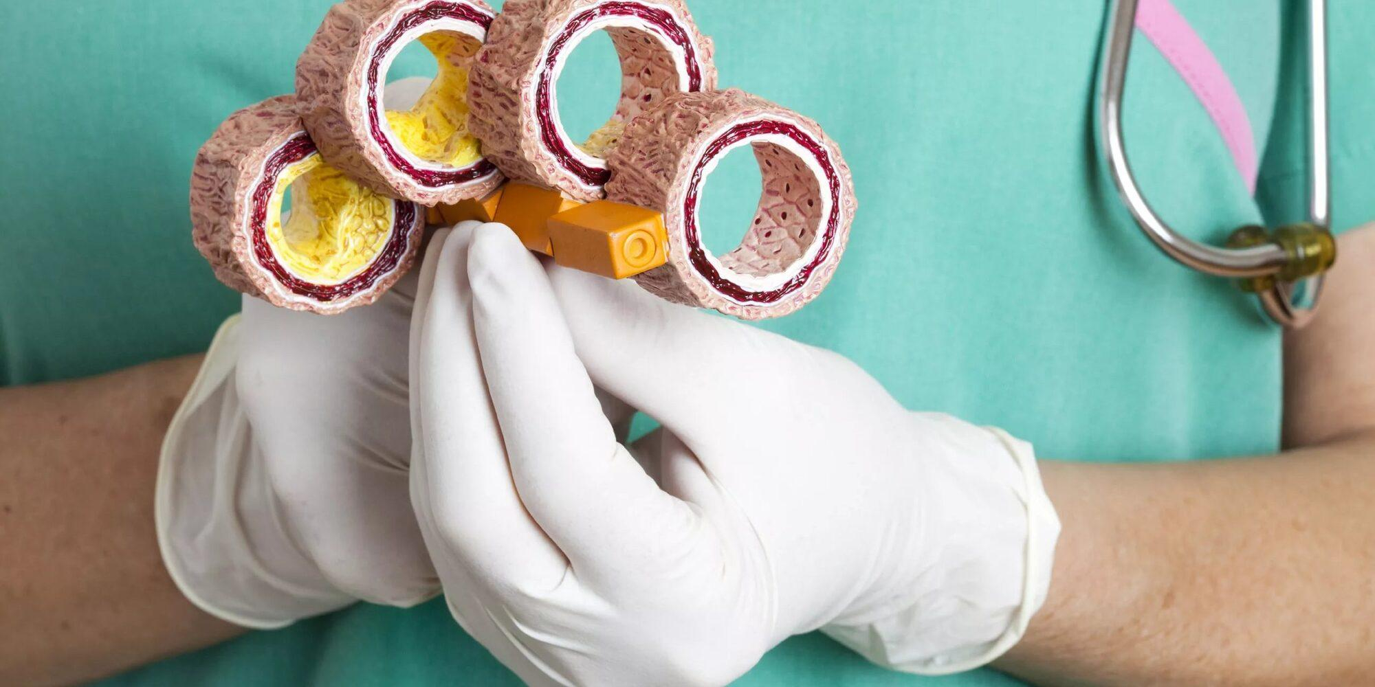 Почему нельзя просто почистить сосуды, – Супрун про атеросклероз