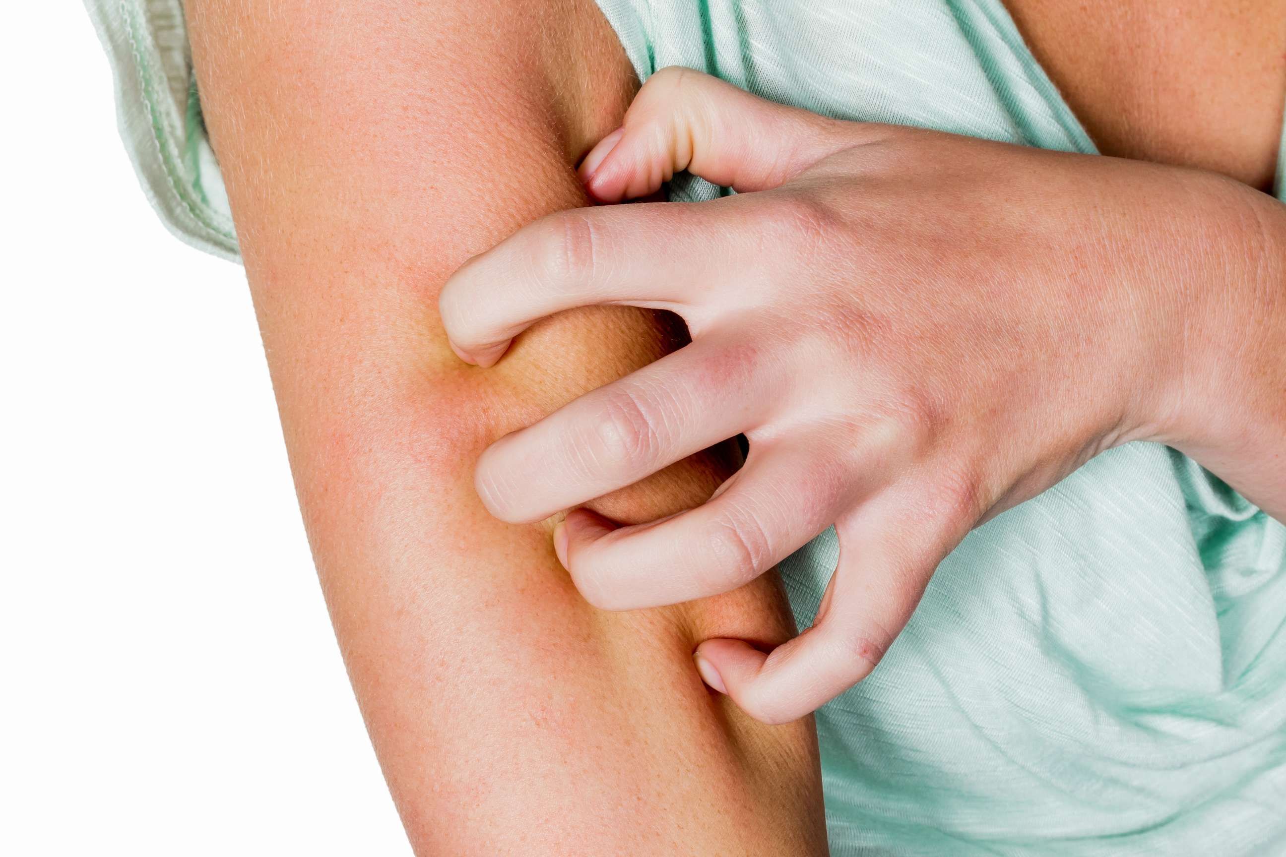 Аллергия на коже – что делать, симптомы, как лечить 