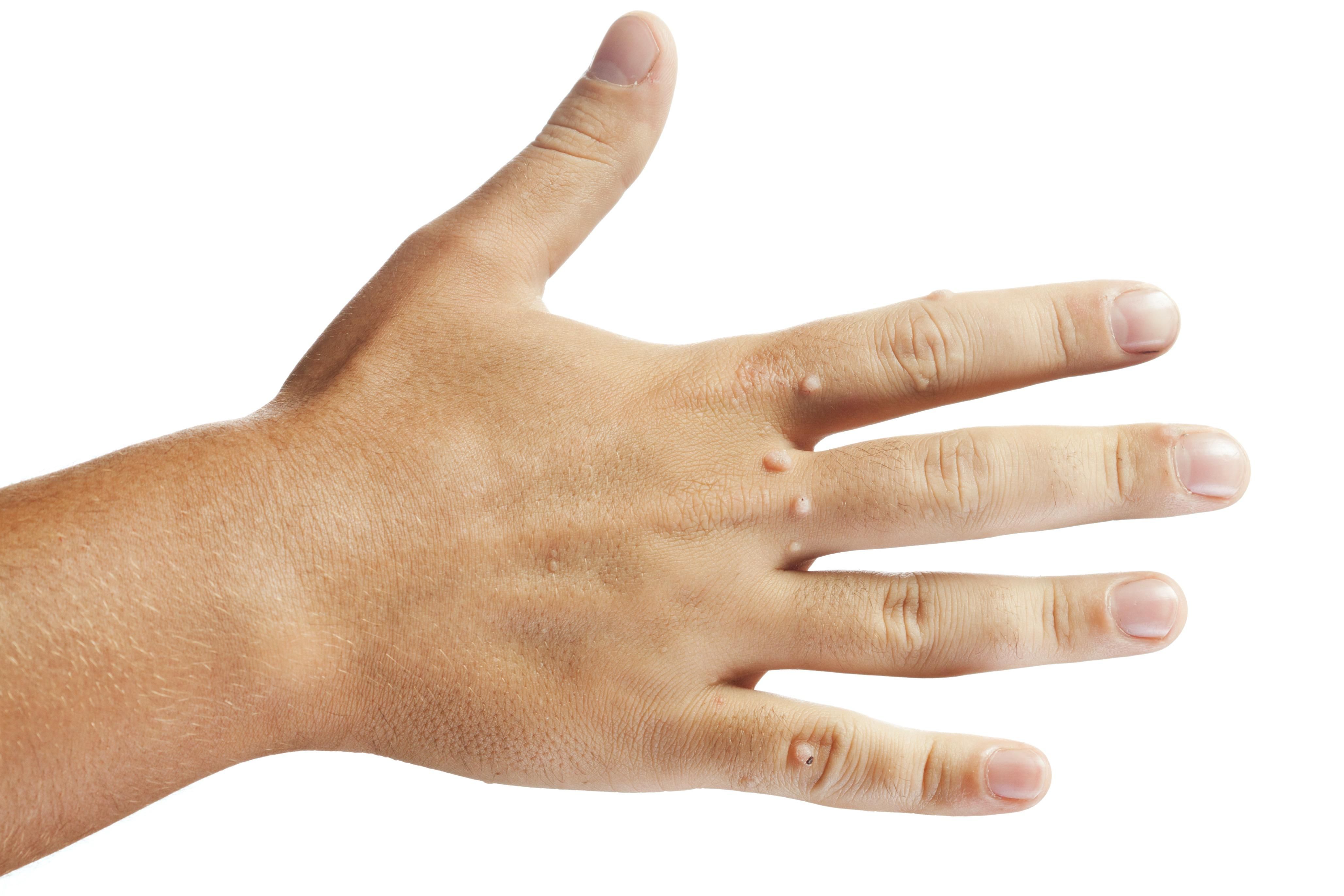 Новий спосіб дозволяє позбавитися бородавок та вугрів за один сеанс Новий спосіб дозволяє позбавитися бородавок та вугрів за один сеанс