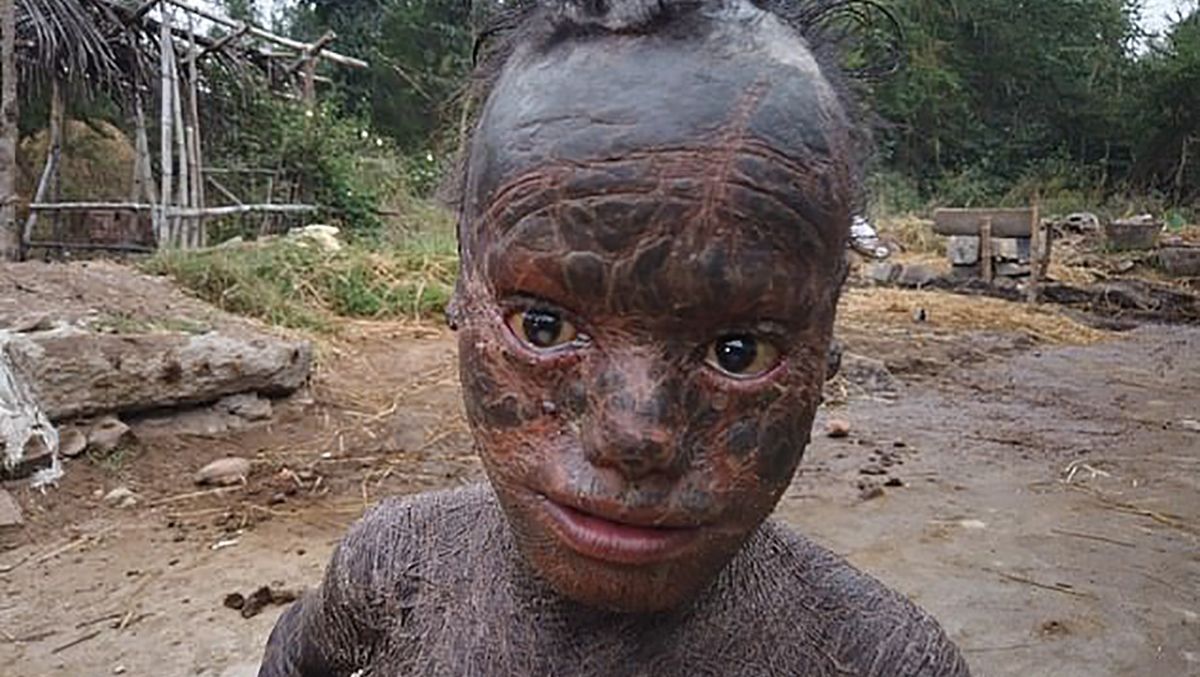 В Индии мальчик покрылся чешуей из-за редкой болезни: фото