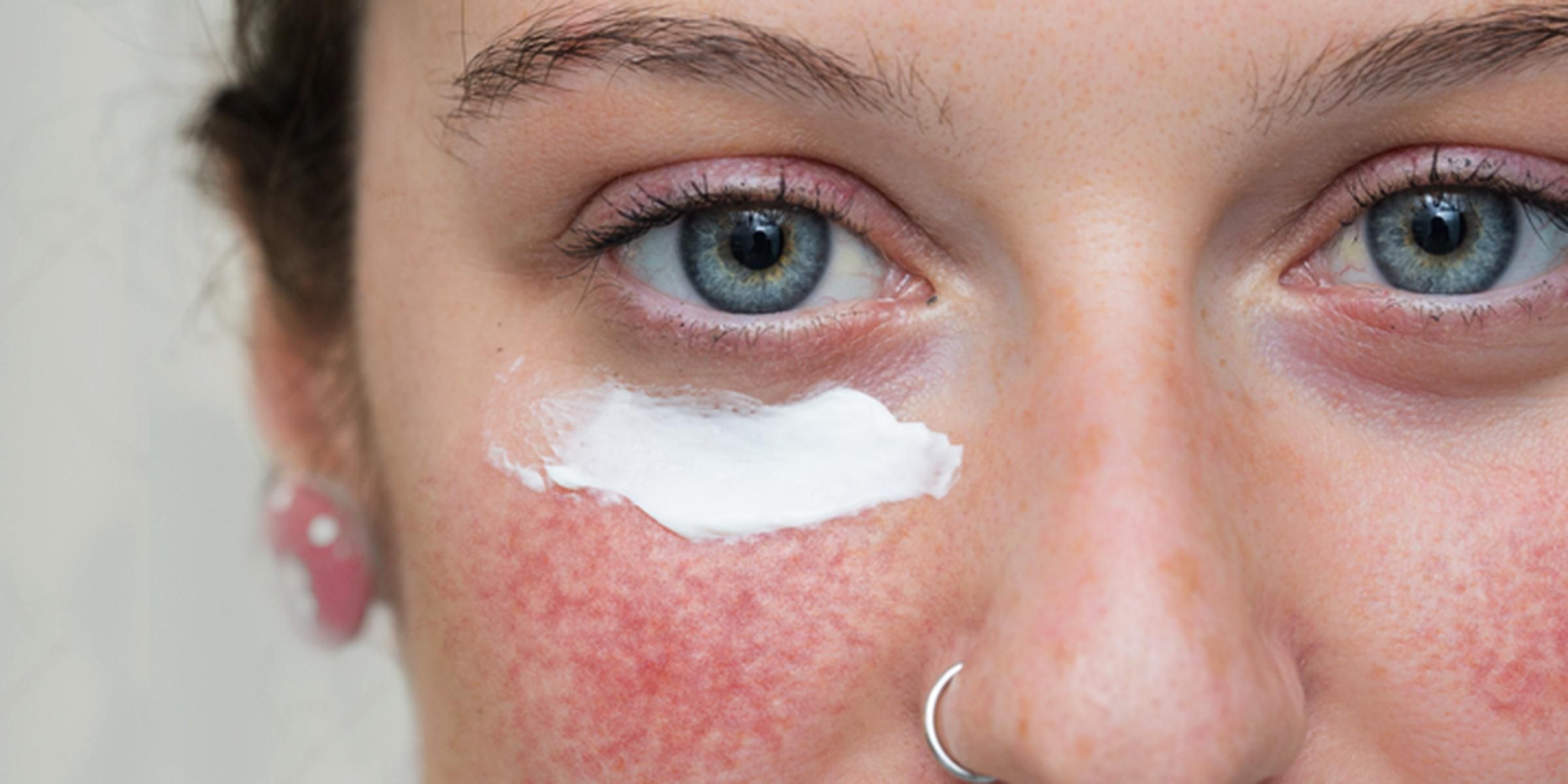 Чому червоніє шкіра обличчя: 8 неочевидних причин 