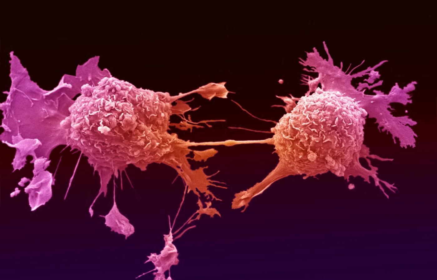 Ультразвук может обезвреживать раковые клетки, не влияя на здоровые