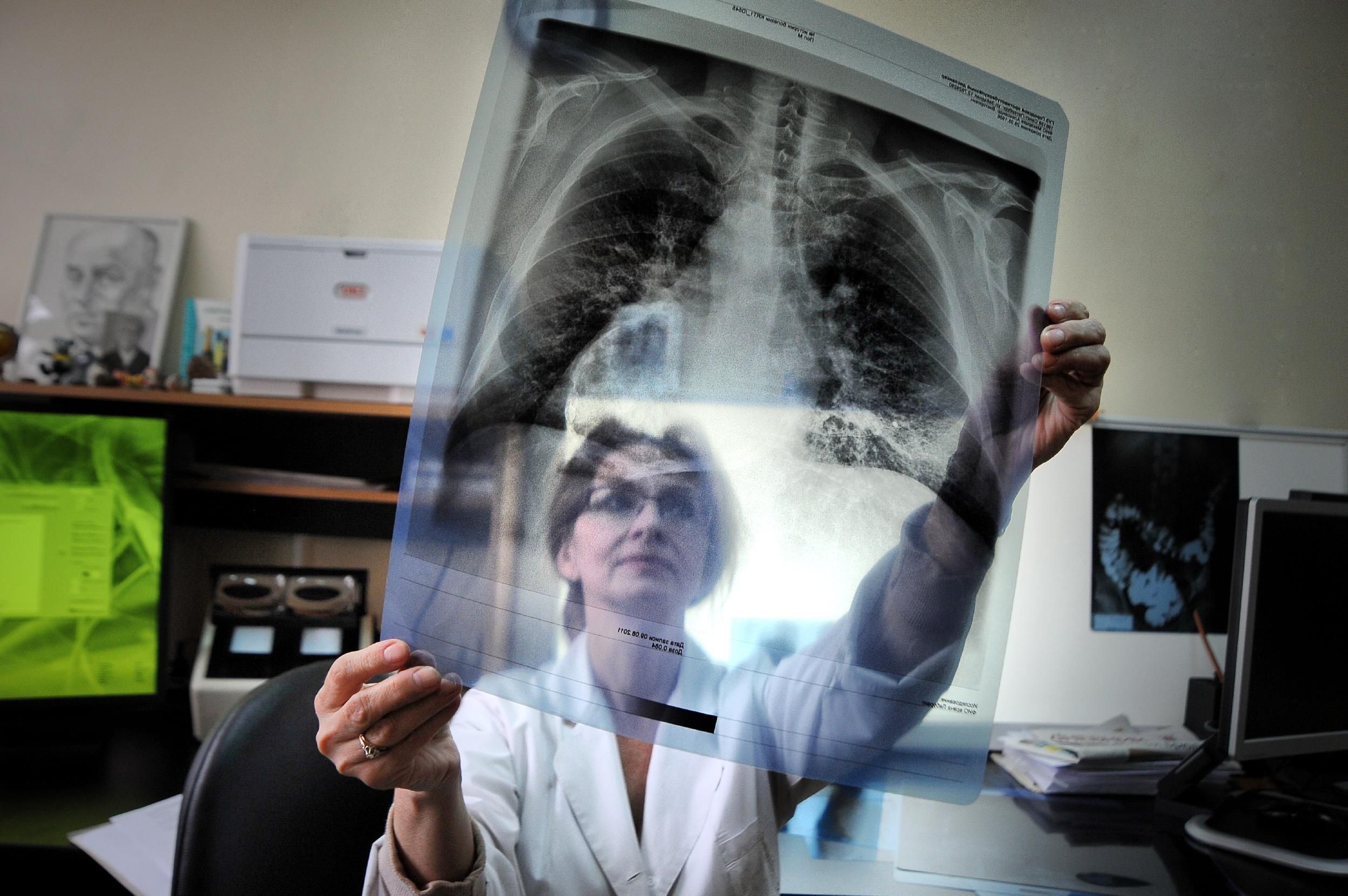 Чи є в Україні епідемія туберкульозу