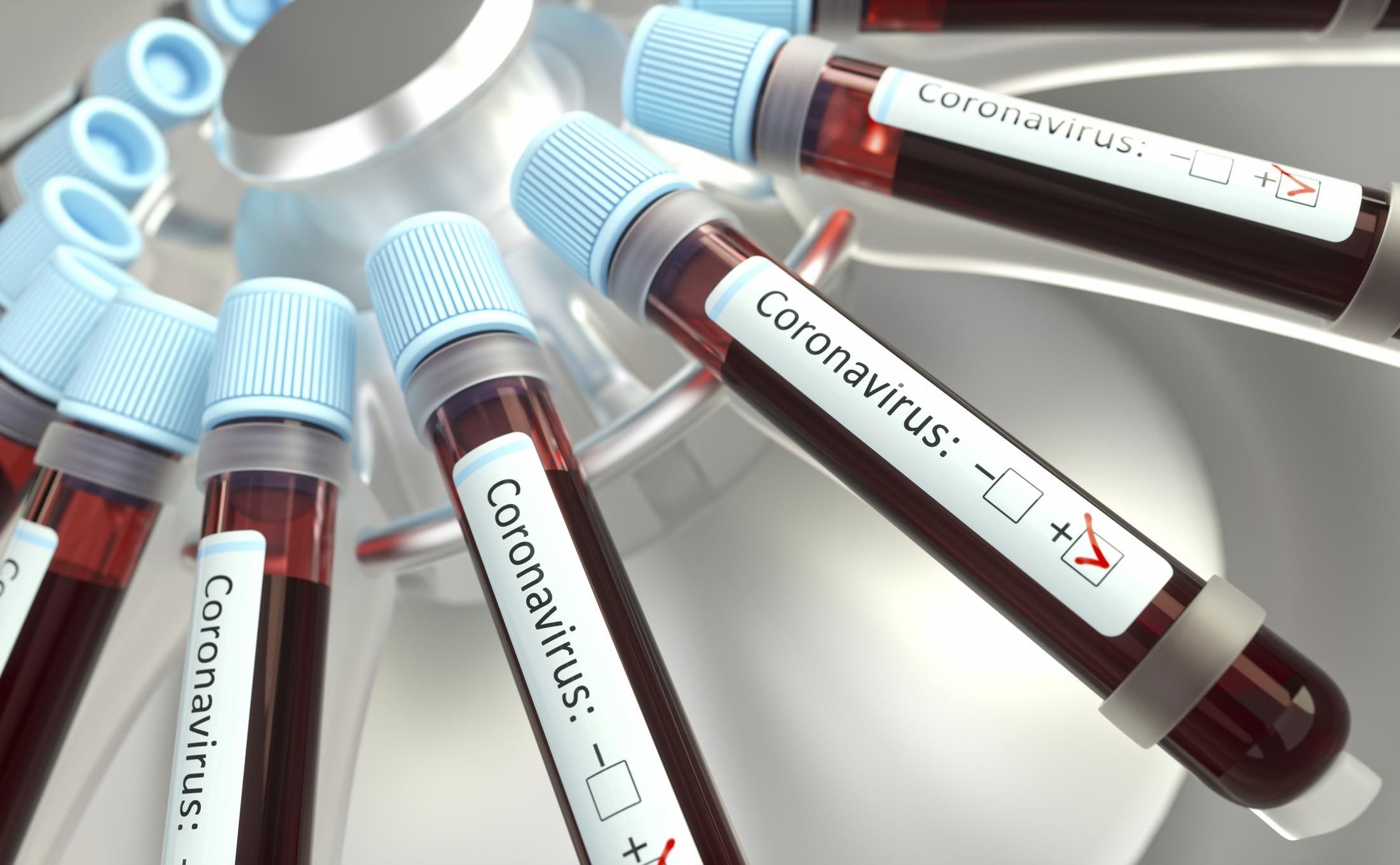 Україна отримає експрес-тести для виявлення коронавірусу за 15 хвилин