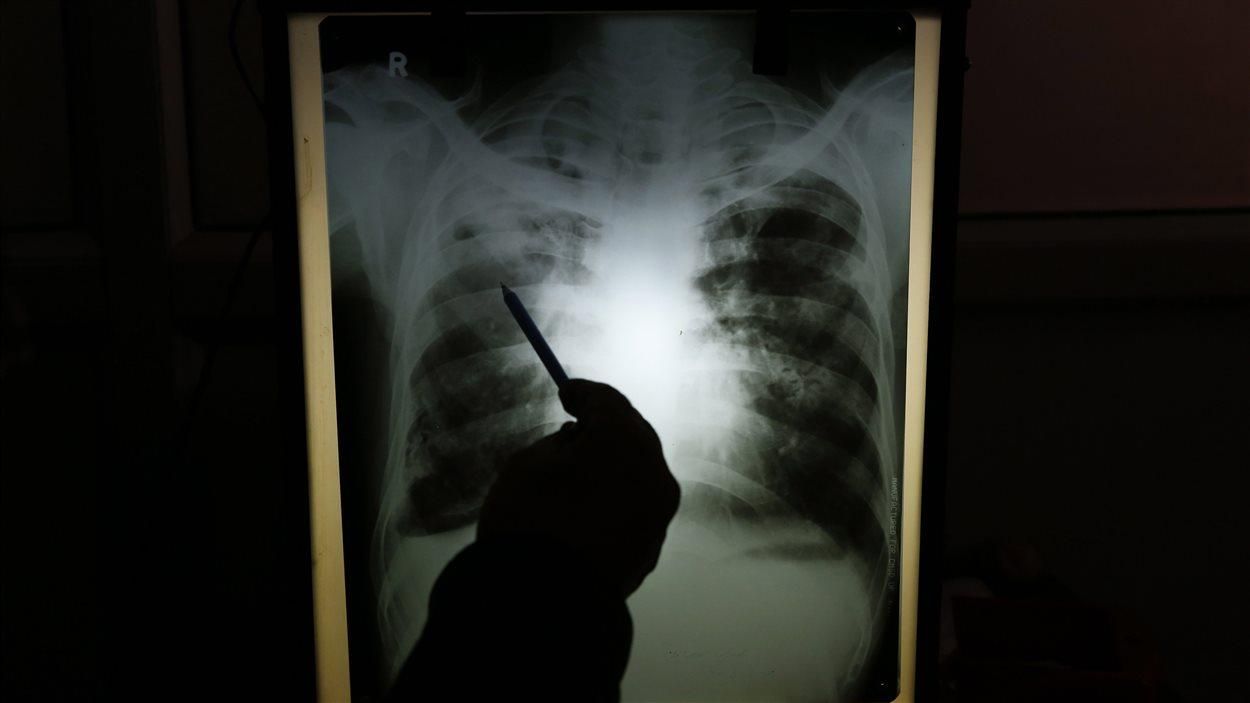 Коронавірус змінює легені: у людей, які одужали вони можуть зменшуватися на 20-30%
