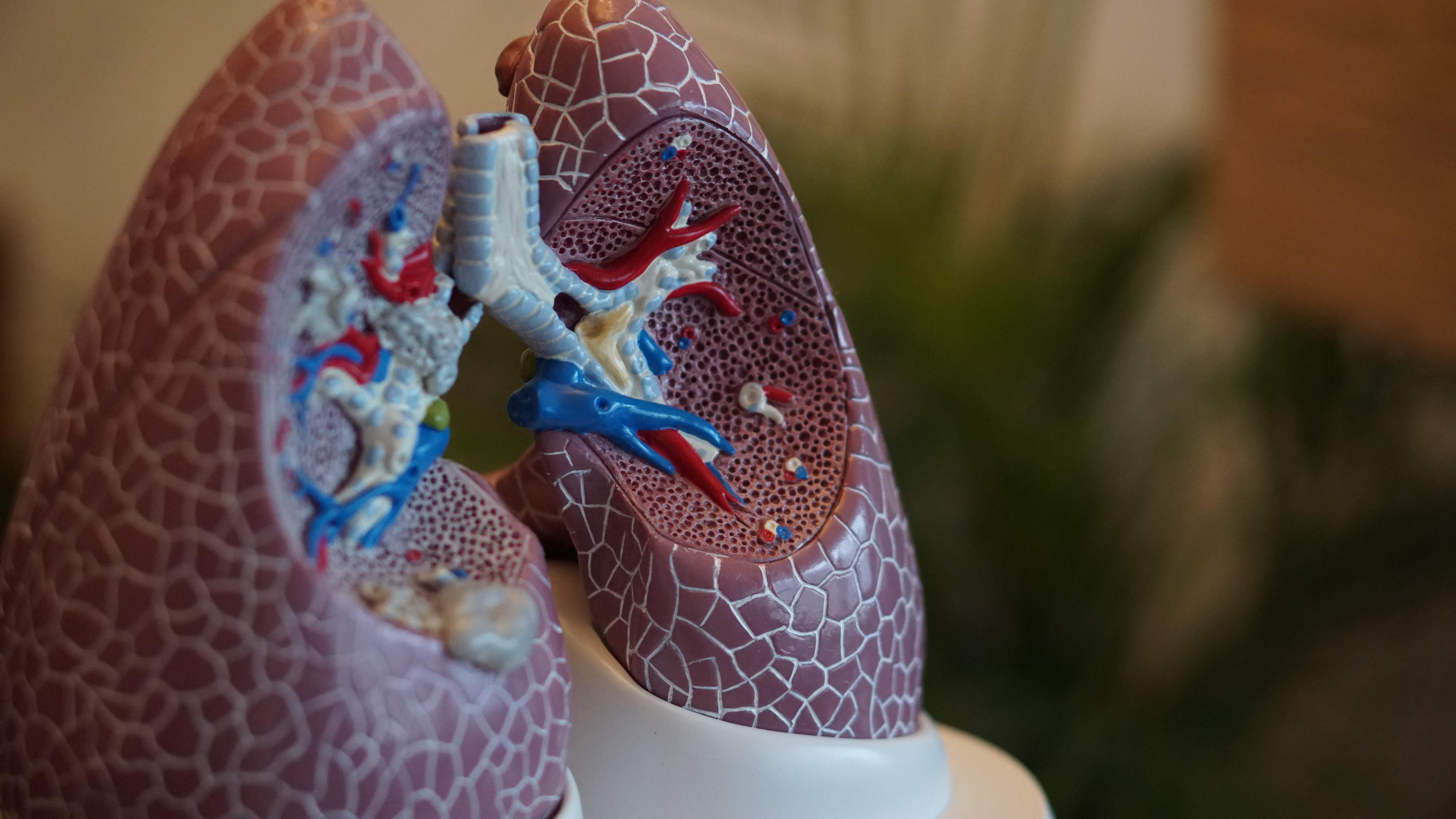 Як змінюються легені хворого на коронавірус: відео