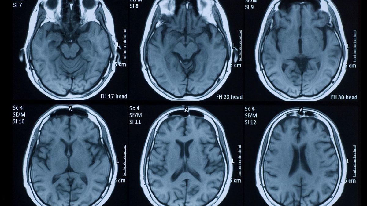 Коронавирус может повреждать мозг: результаты исследования