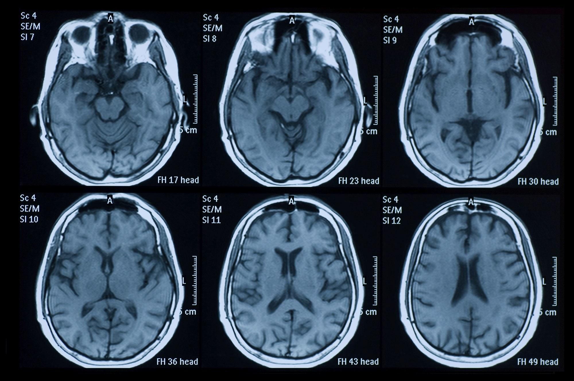 Коронавирус может повреждать мозг: результаты исследования