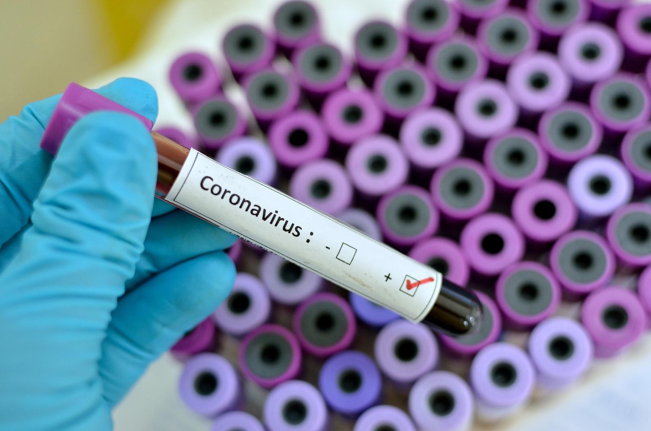 В Україні підтвердили 11 913 випадків інфікування коронавірусом COVID-19