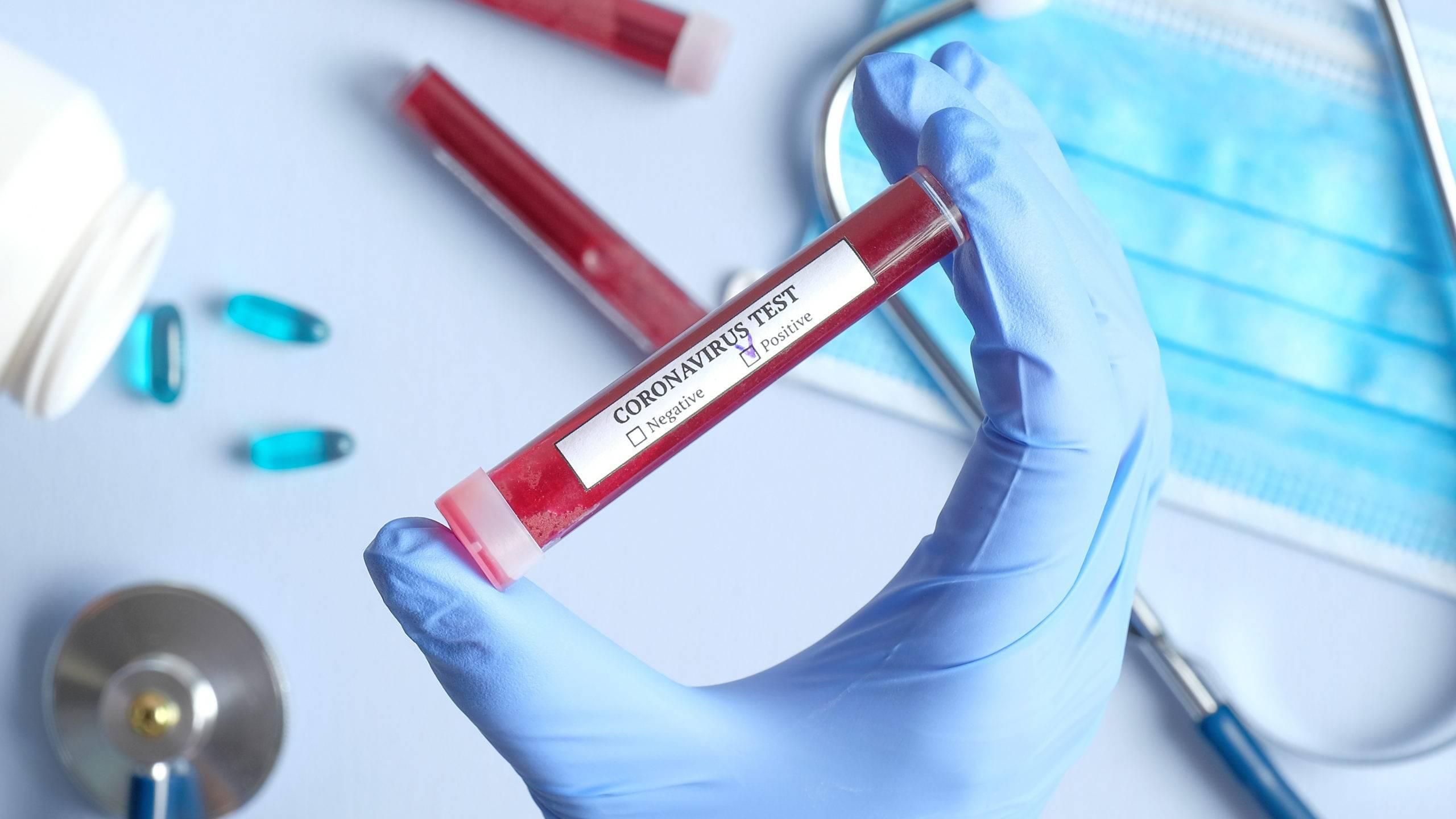 В Європі схвалили тест на антитіла до коронавірусу, його точність 99%
