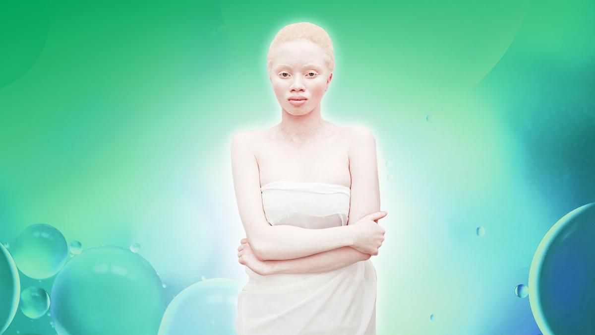 Альбинизм – что это такое, как живут люди-альбиносы