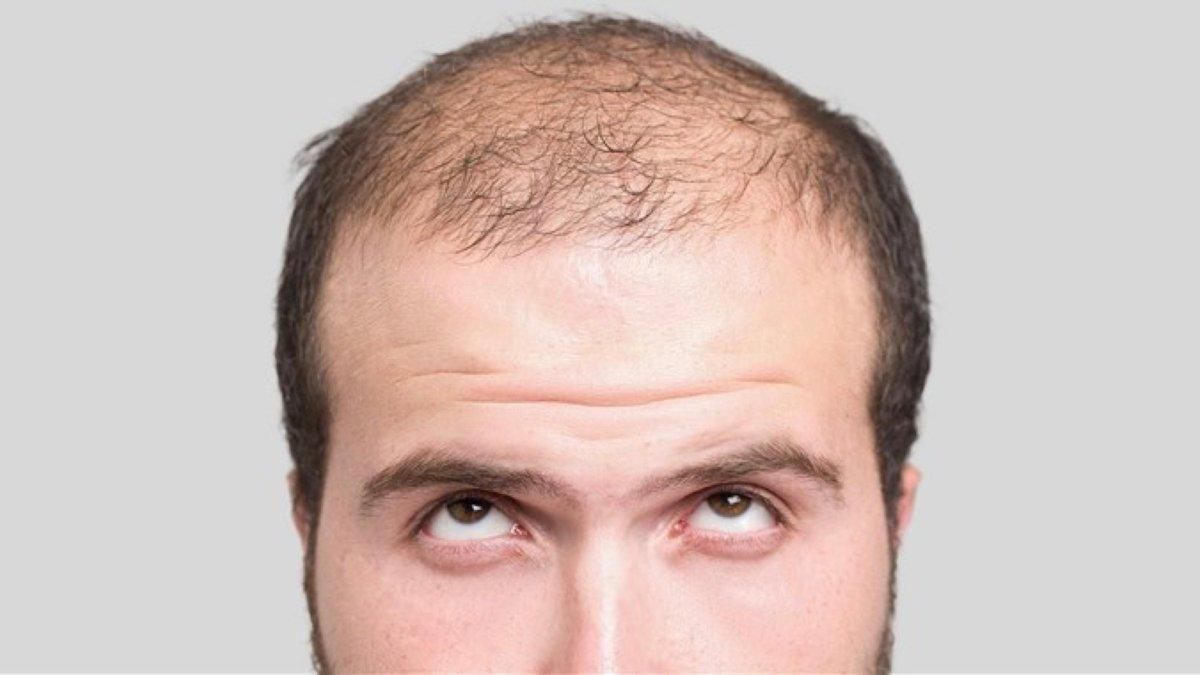 Знайшли новий метод відновлення волосся: молекула, яка зупинить облисіння