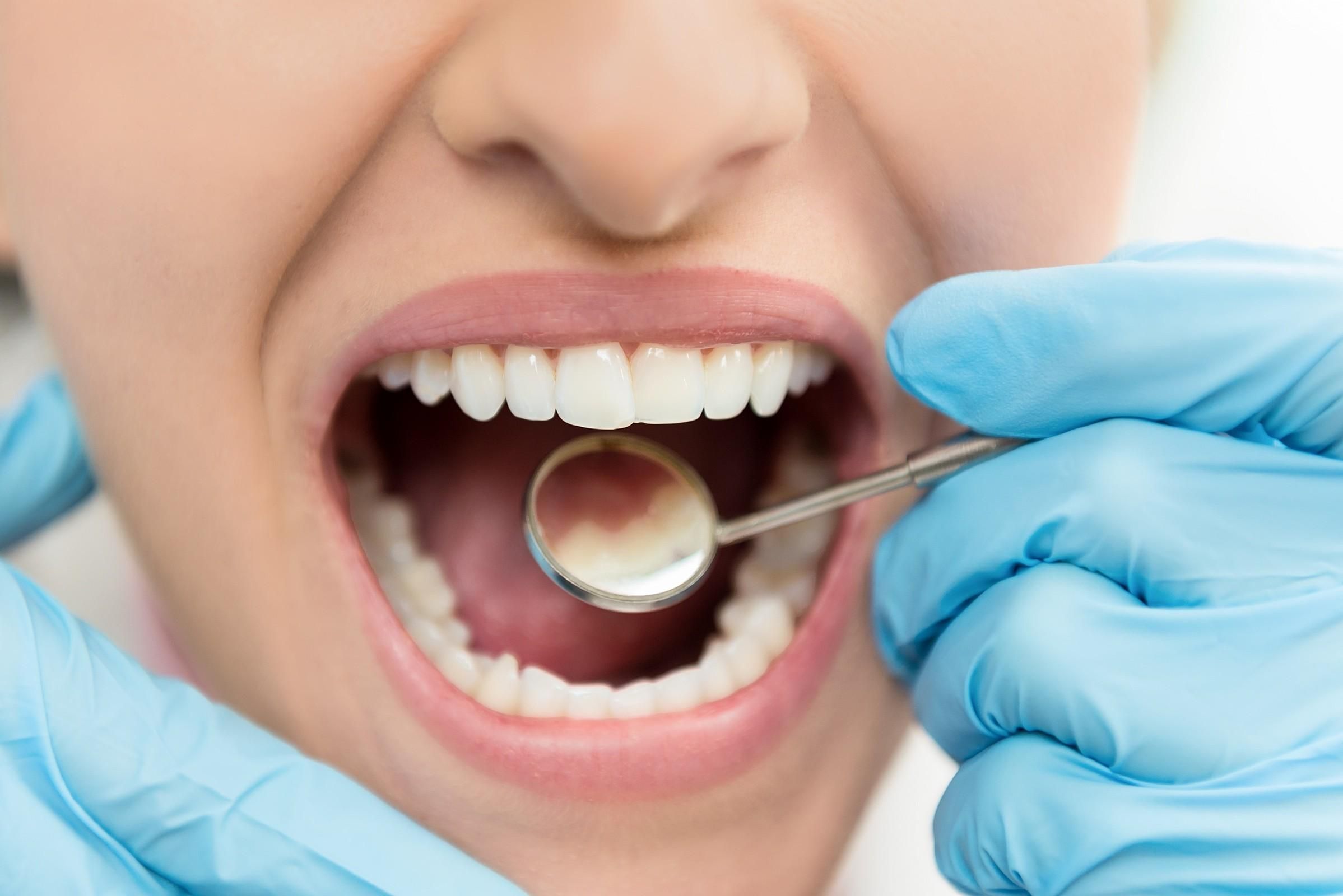 Знайшли покриття, яке захистить зуби від карієсу