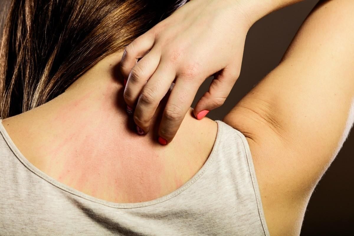 Дряпання шкодить шкірі: назвали дієвіший спосіб заспокоїти свербіж