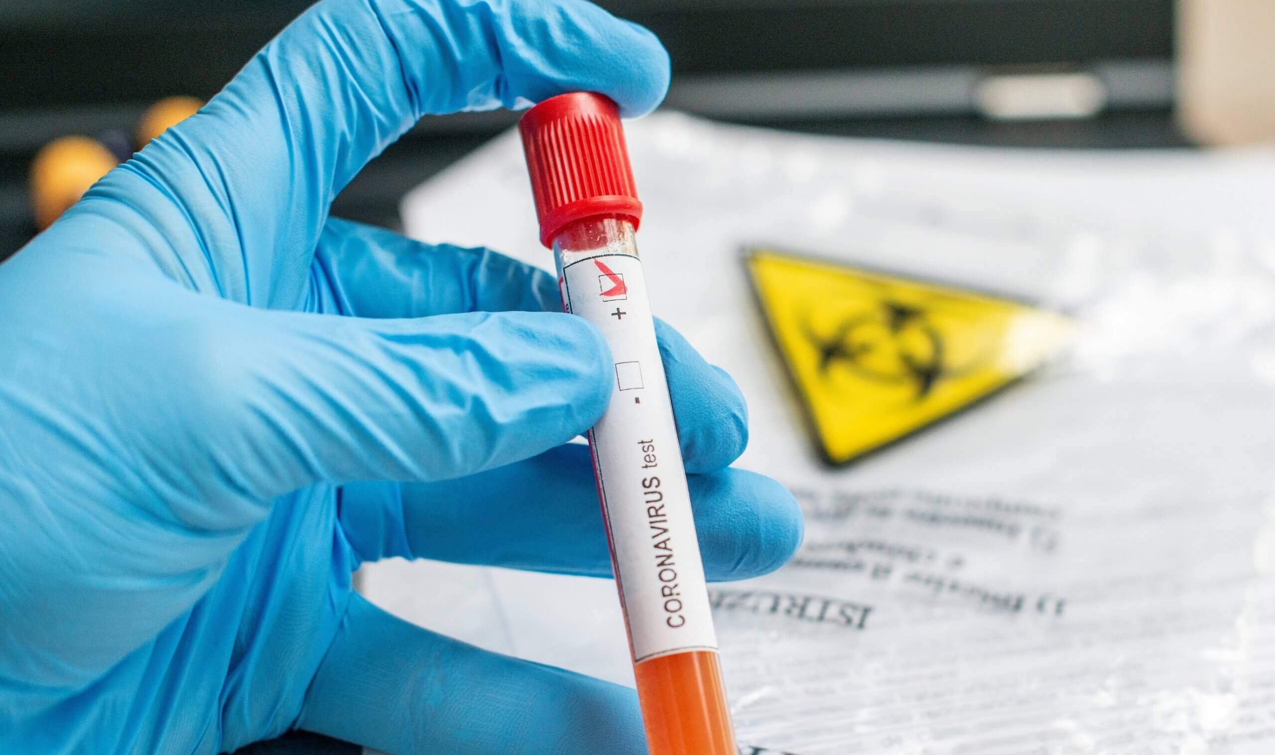 Новий пристрій виявляє коронавірус, рівень антитіл та важкість захворювання за 10 хвилин Новий пристрій виявляє коронавірус, рівень антитіл та важкість захворювання за 10 хвилин