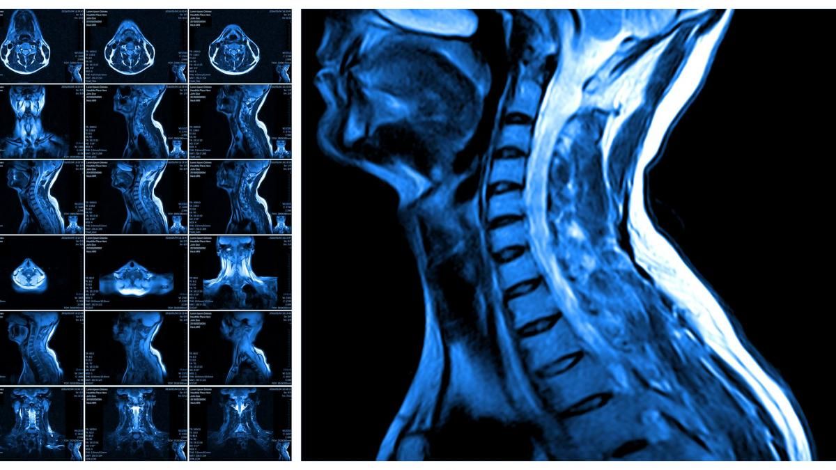 Травми спинного мозку: знайшли спосіб зменшити шкоду