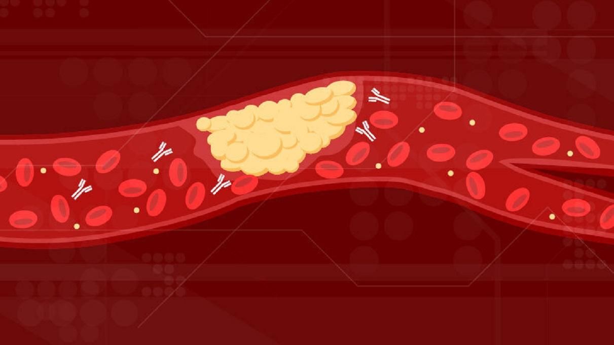 Образование тромбов при коронавирусе Образование тромбов при коронавирусе