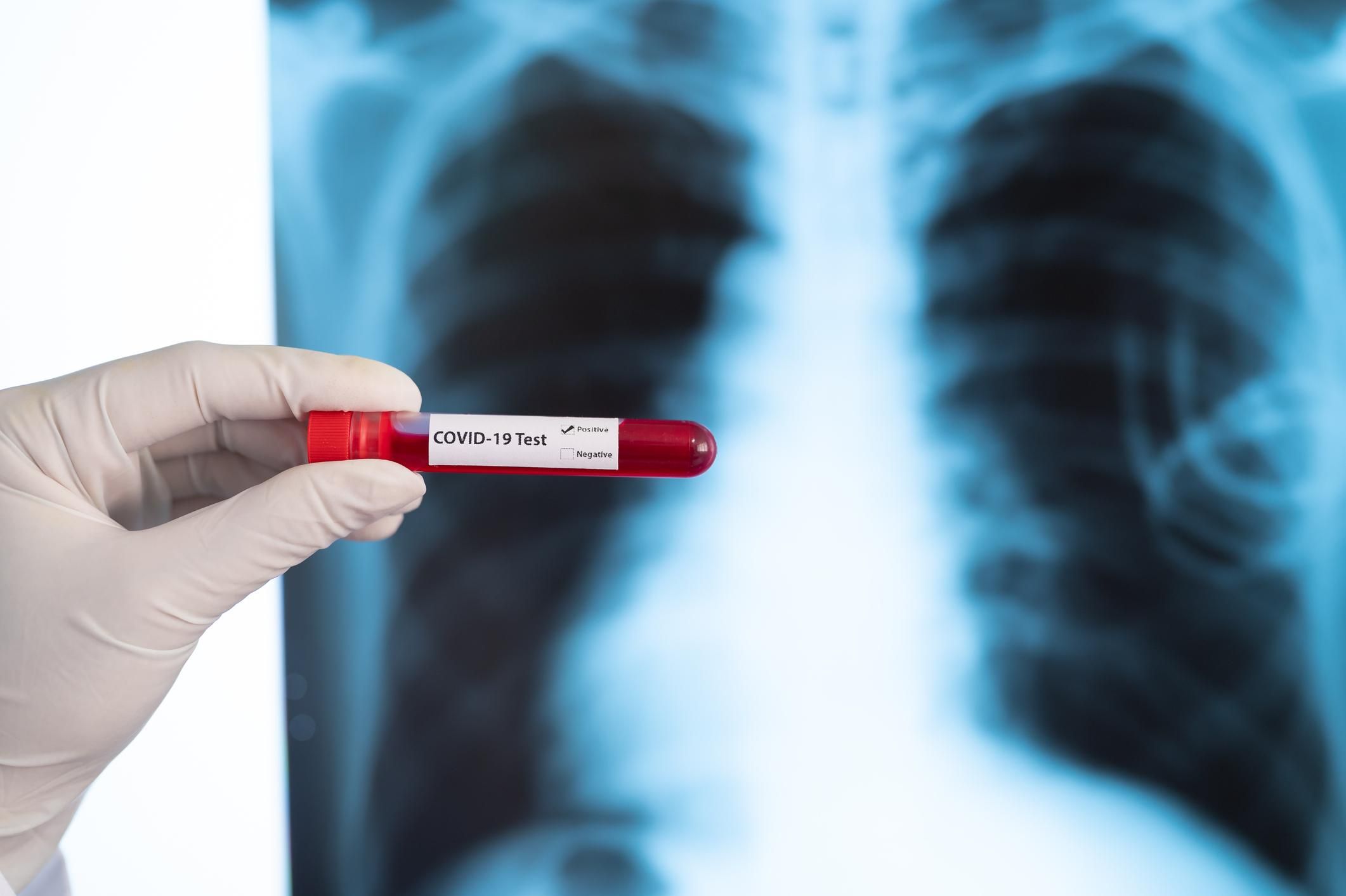 Дослідження: COVID-19 уражає легені більше, ніж вважалося раніше Дослідження: COVID-19 уражає легені більше, ніж вважалося раніше