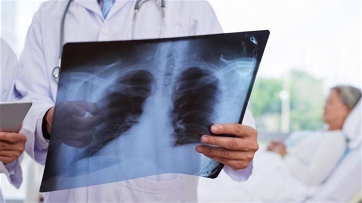 Туберкулез, рак легких и вред курения, астма – мифы о болезнях легких
