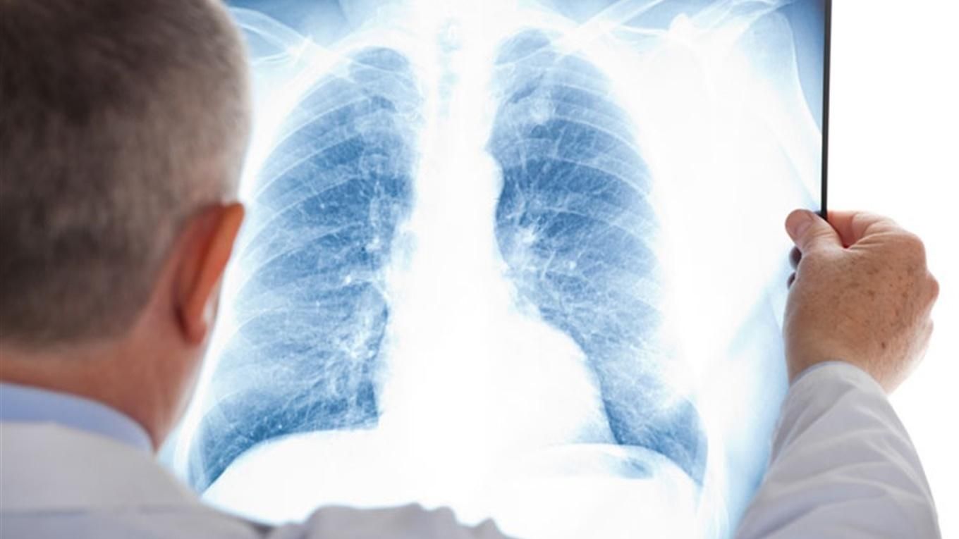 Чому розвивається рак легенів у некурців: назвали новий фактор 
