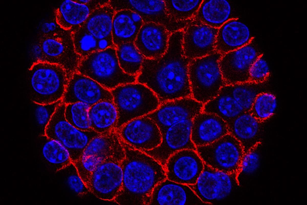 Ракові клітини впадають у "сплячку", щоб перечекати хімієтерапію: дослідження